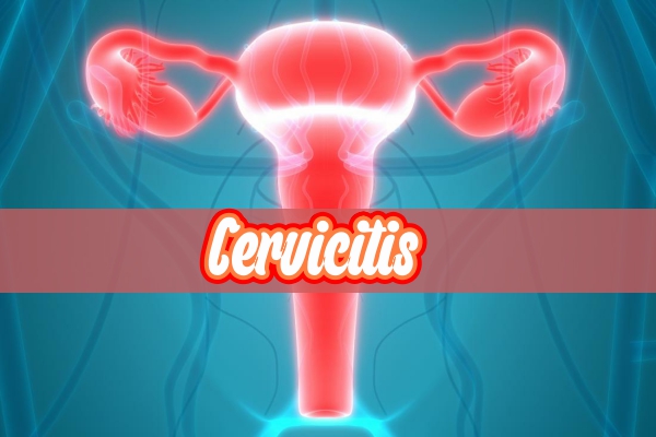 Cervicitis