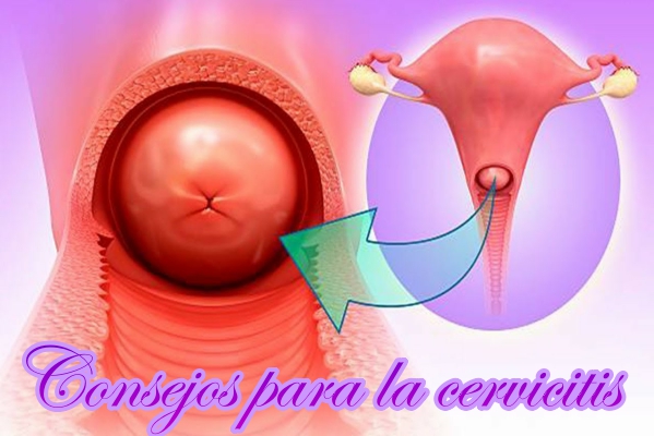 Consejos para la cervicitis