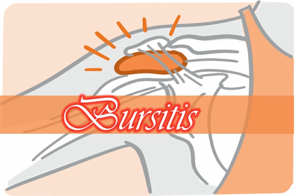 Bursitis