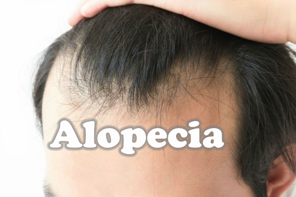 Alopecia