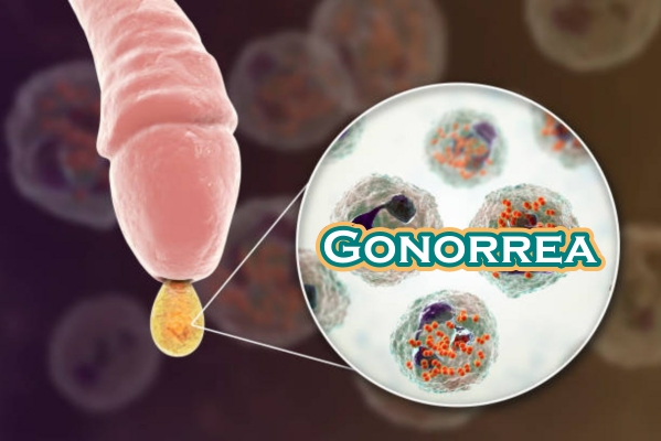 Gonorrea