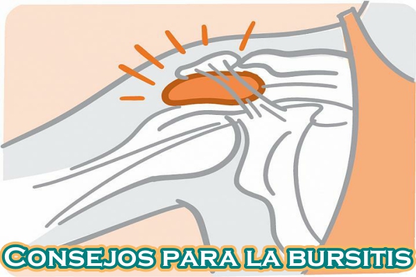 Consejos para la bursitis