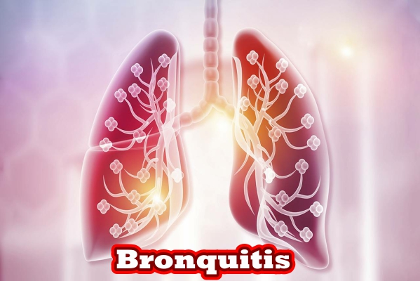 Bronquitis