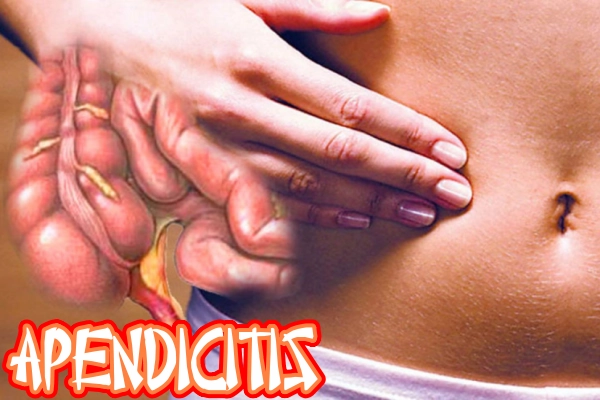 Apendicitis