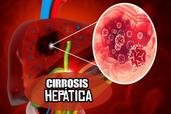 Cirrosis hepática