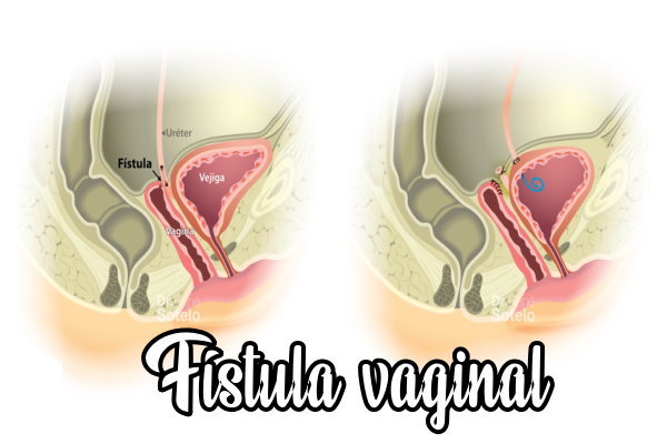 Fístula Vaginal: Comprendiendo una Condición Femenina Dolorosa