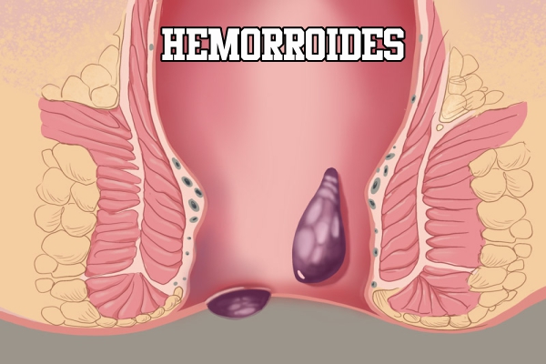 Hemorroides: Todo lo que Necesitas Saber