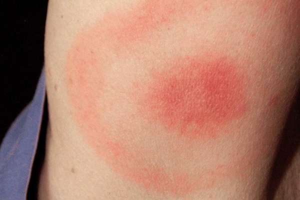 Enfermedad de Lyme: